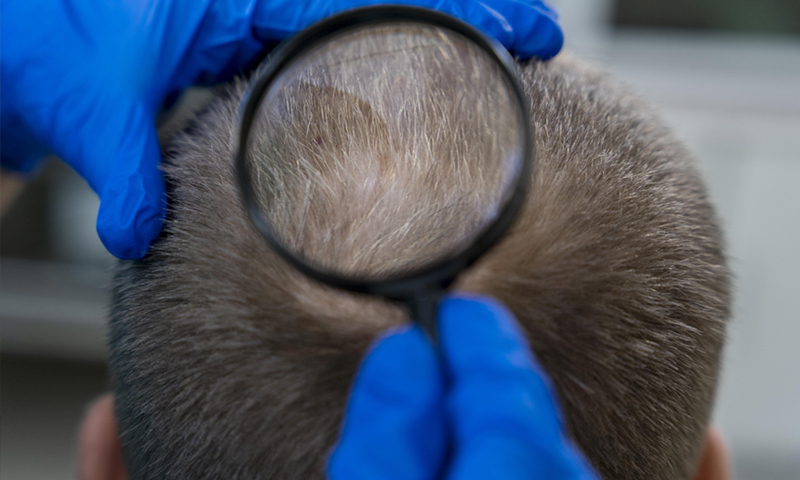 Alopecia-Areata- Diagnosis- management
